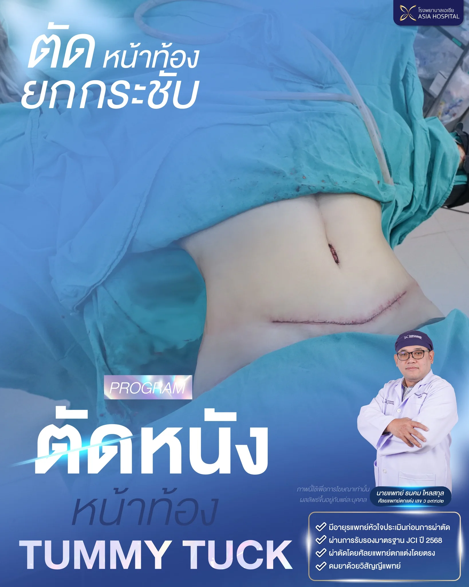 รีวิวตัดหนังหน้าท้อง-ย้ายสะดือ