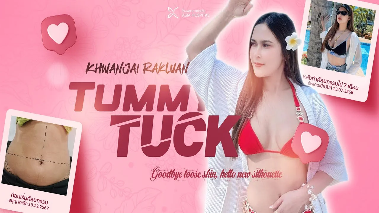 รีวิวตัดหนังหน้าท้อง ย้ายสะดือ แต่งสะดือ