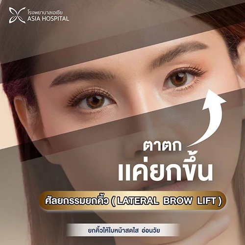 ยกคิ้ว ส่องกล้อง Endoscopic | โรงพยาบาลเอเซีย | โรงพยาบาลเอเซีย ยกคิ้ว-ยกหางตา