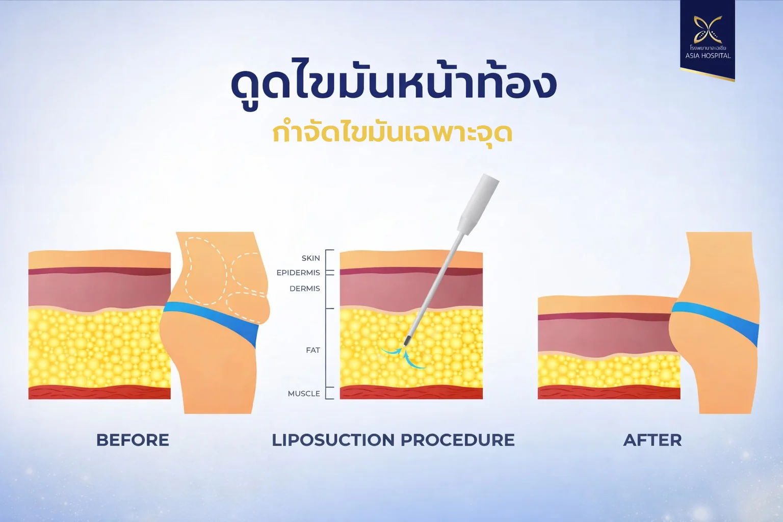 abdominal-liposuction-ดูดไขมันหน้าท้อง