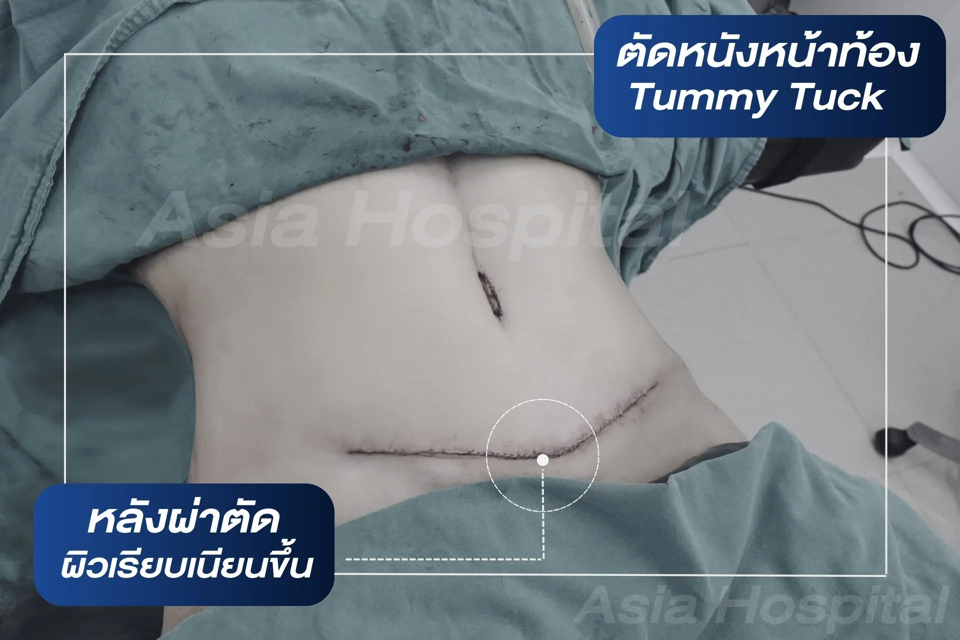 ผลลัพธ์หลังตัดหนังหน้าท้องที่โรงพยาบาลเอเซีย
