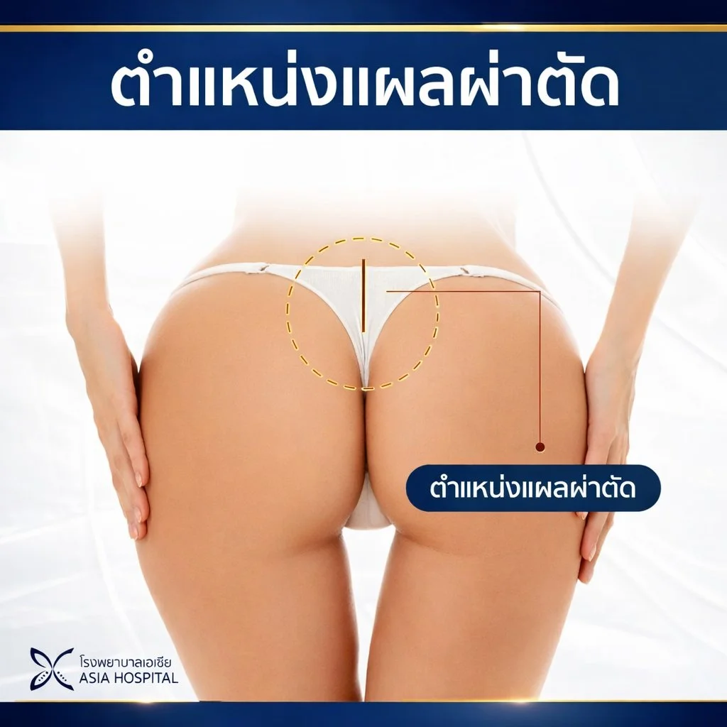 ตำแหน่งแผลผ่าตัดเสริมสะโพก