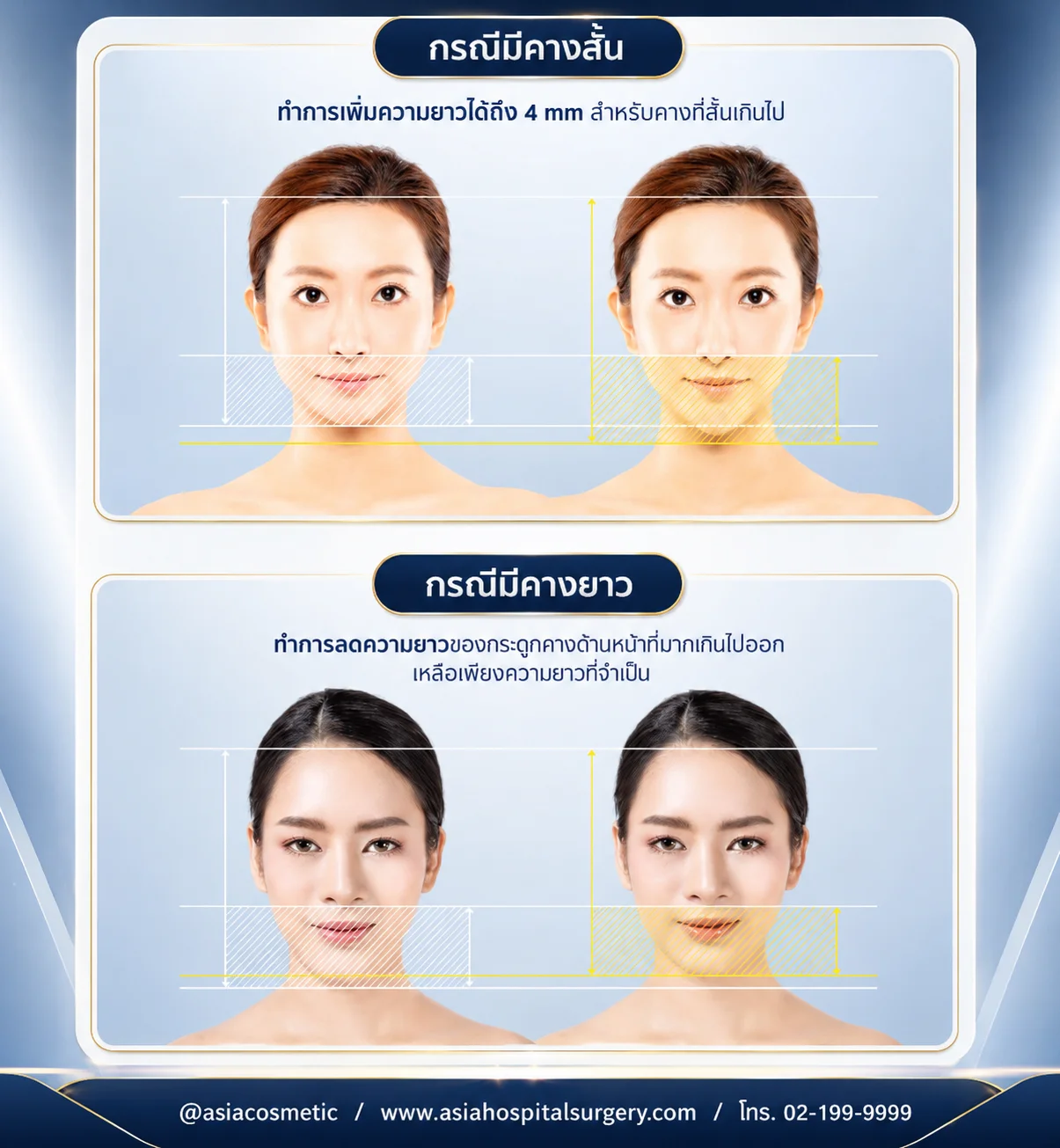 คางสั้น-คางยาว-ปรับรูปหน้า-วีไลน์-V-Line
