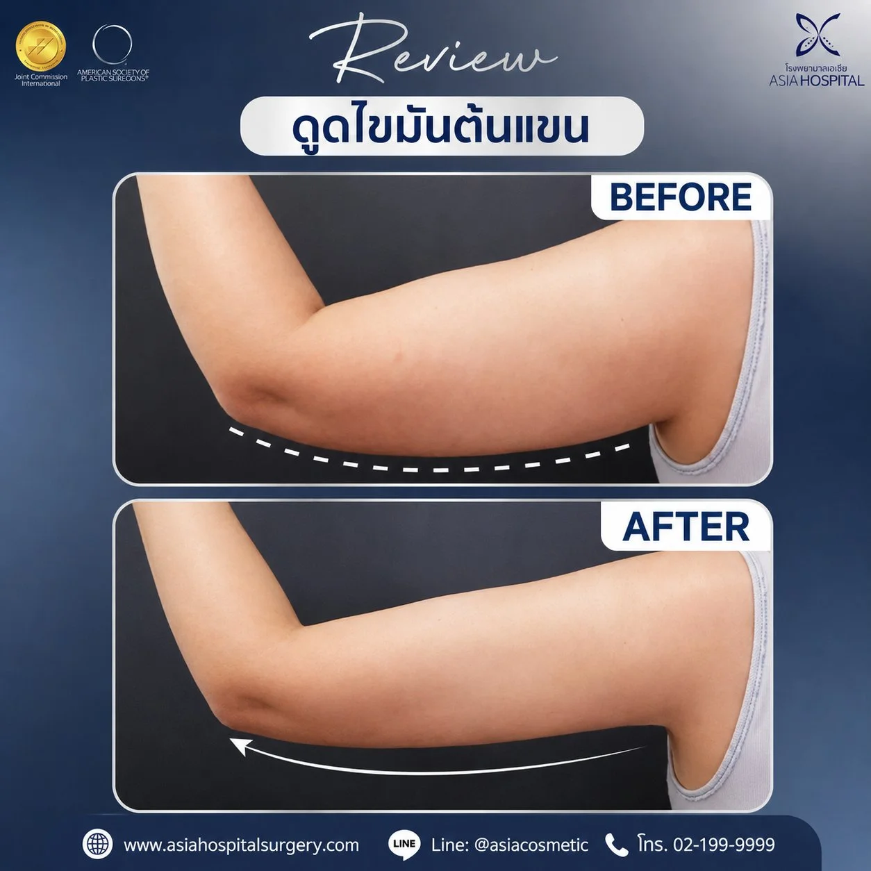 รีวิวดูดไขมันต้นแขน
