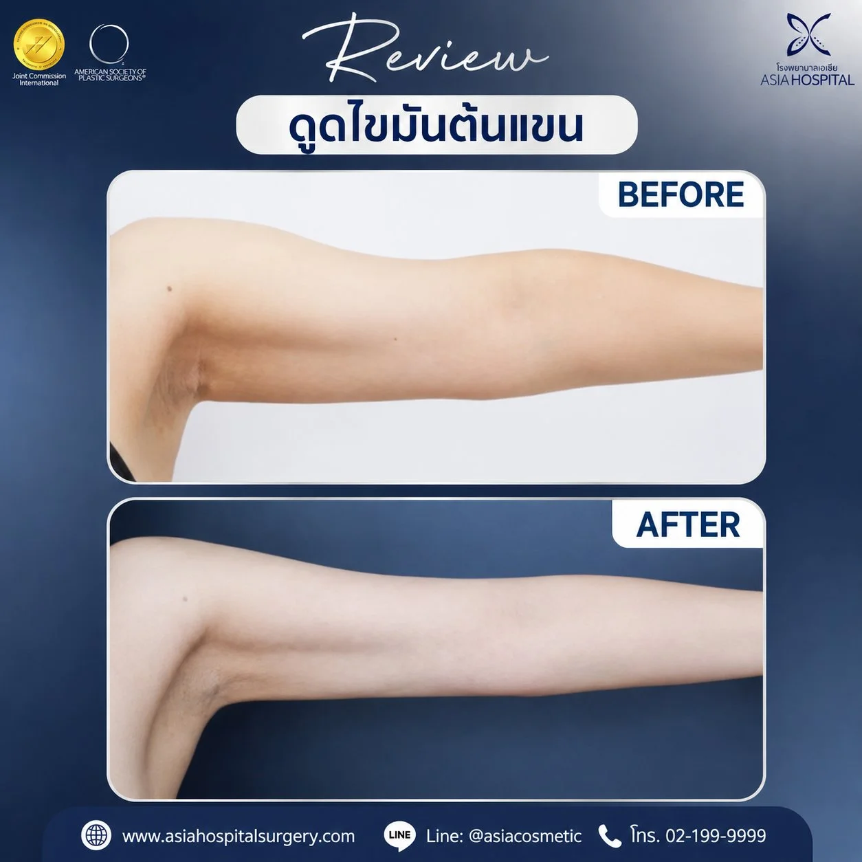 รีวิวดูดไขมันต้นแขน