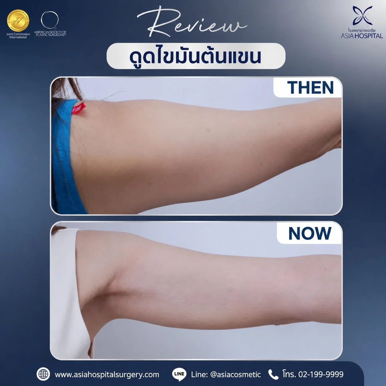 รีวิวดูดไขมันต้นแขน-ดูดไขมันต้นแขน Arm Liposuction