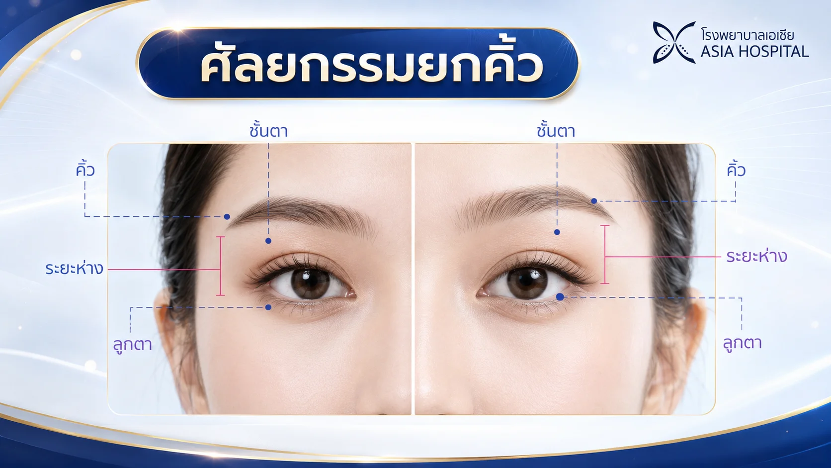 ศัลยกรรมยกคิ้ว ยกหางตา | โรงพยาบาลเอเซีย | โรงพยาบาลเอเซีย ศัลยกรรมยกคิ้ว-ยกหางตา