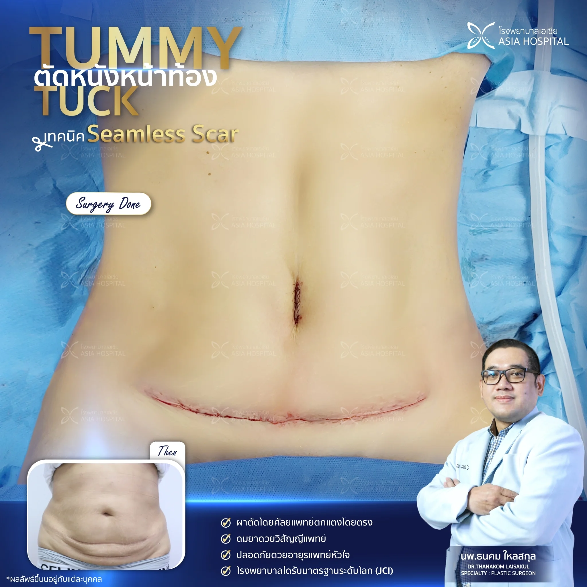 รีวิวตัดหนังหน้าท้อง
