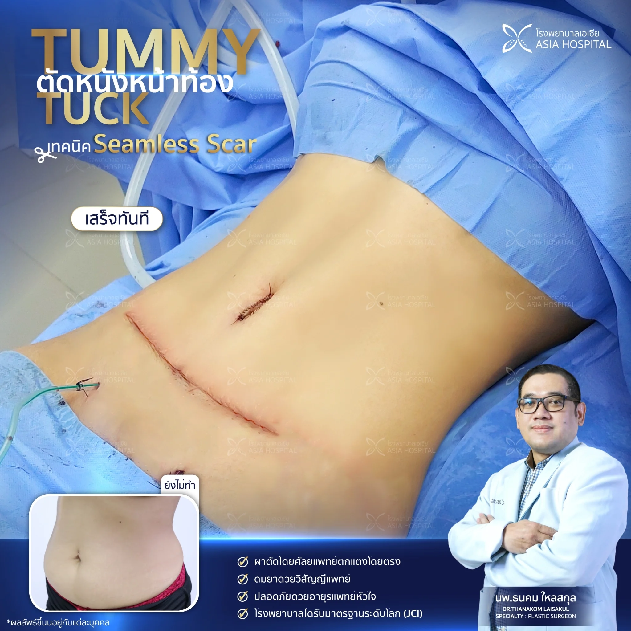 รีวิวตัดหนังหน้าท้อง