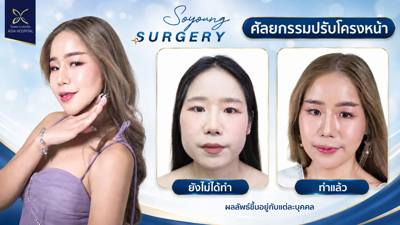 รีวิวปรับรูปหน้า-วีไลน์