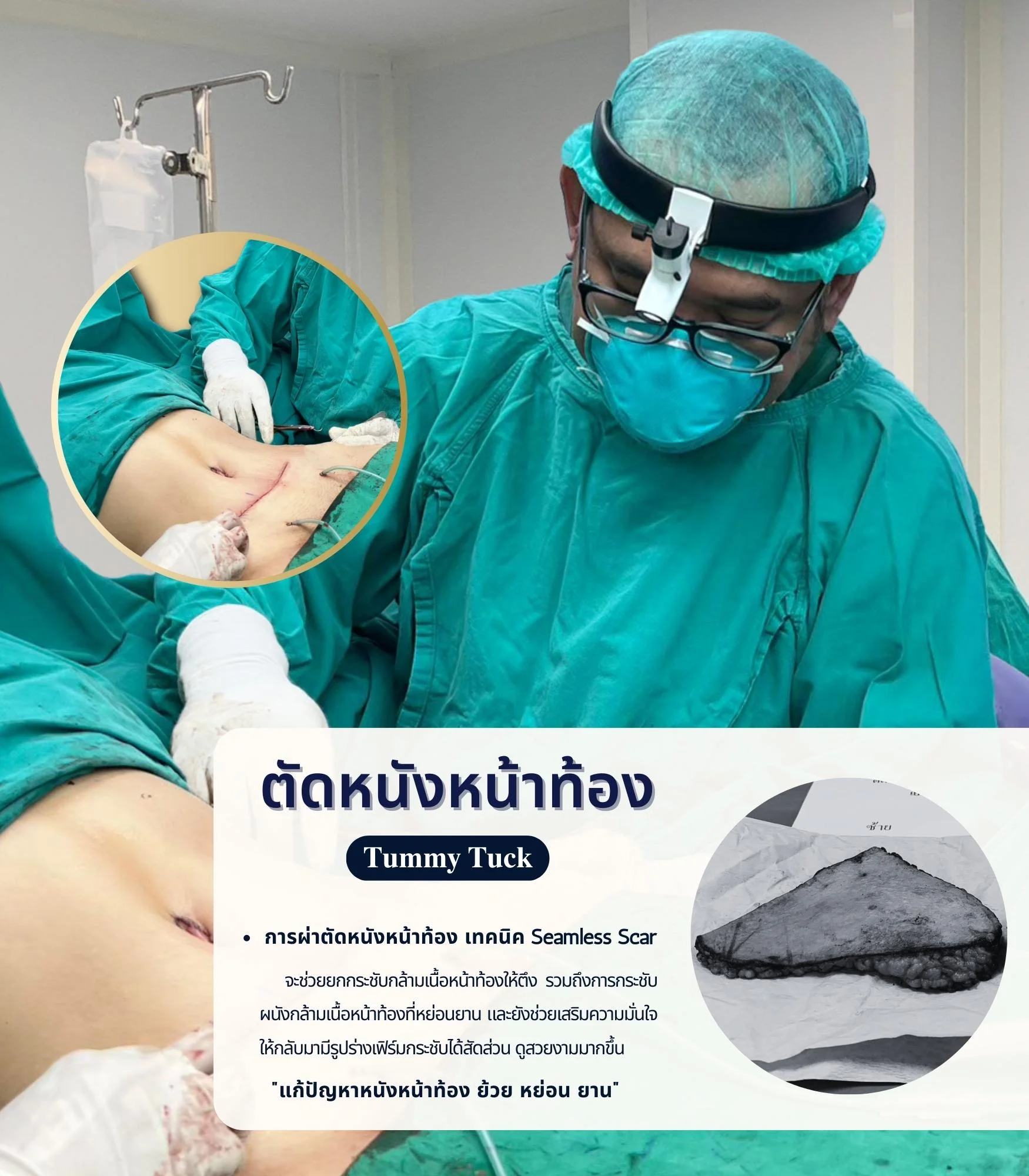 ตัดหนังหน้าท้องแผลเล็ก seamless scar