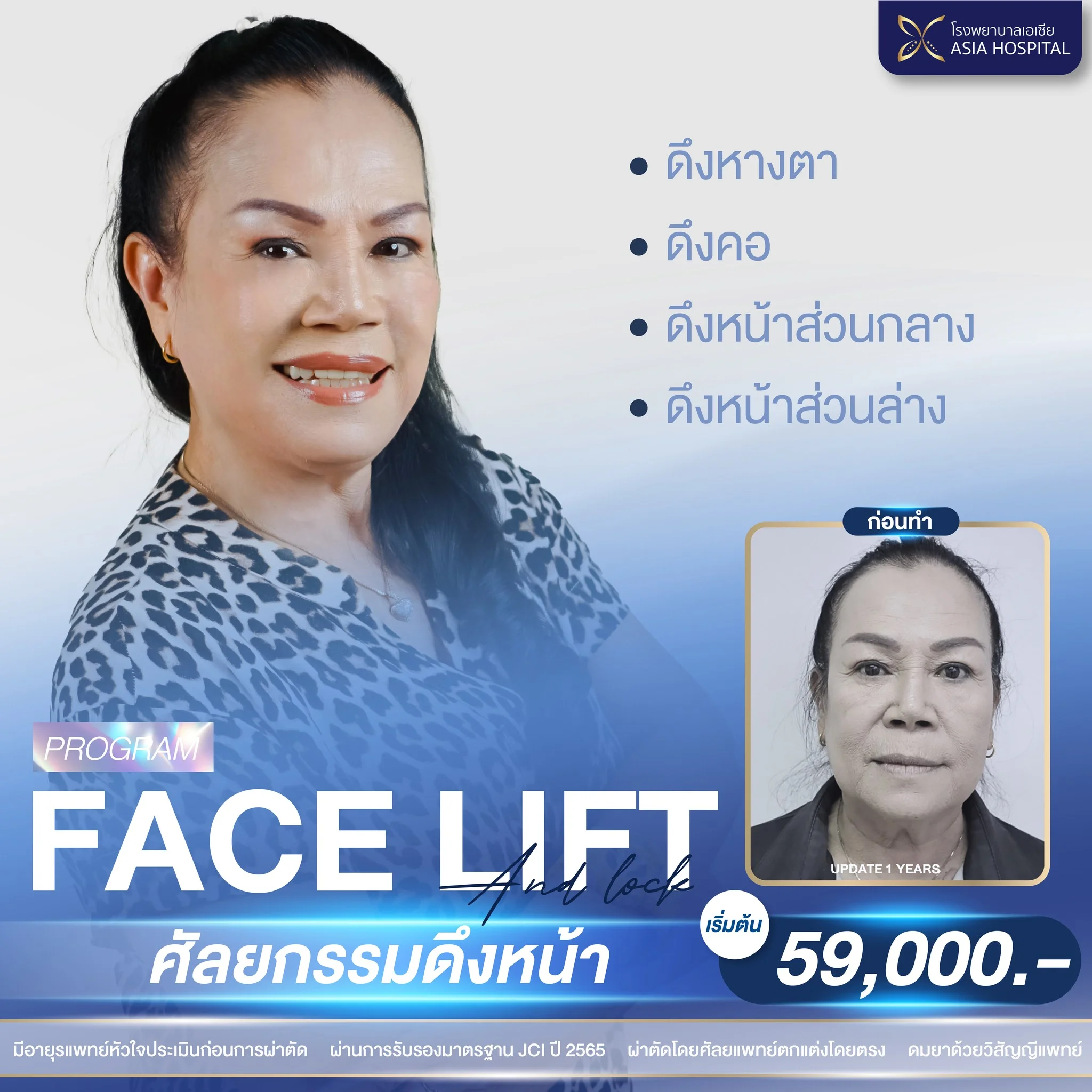 รีวิวดึงหน้า_ดึงหน้าแผลเล็ก Mini Facelift