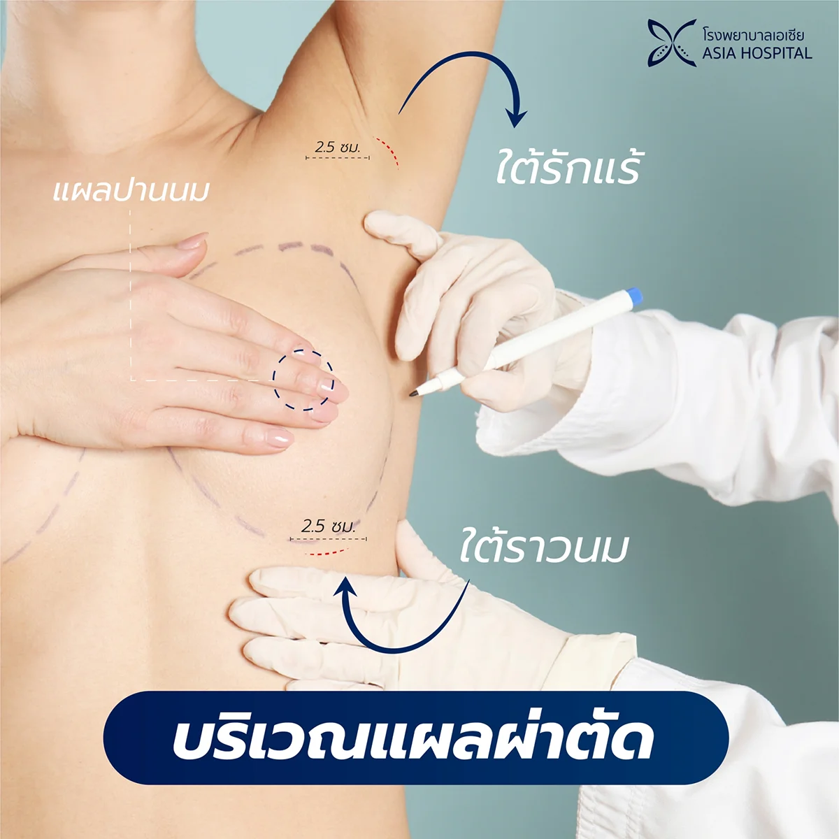 ตำแหน่งแผลผ่าตัด_เสริมหน้าอก