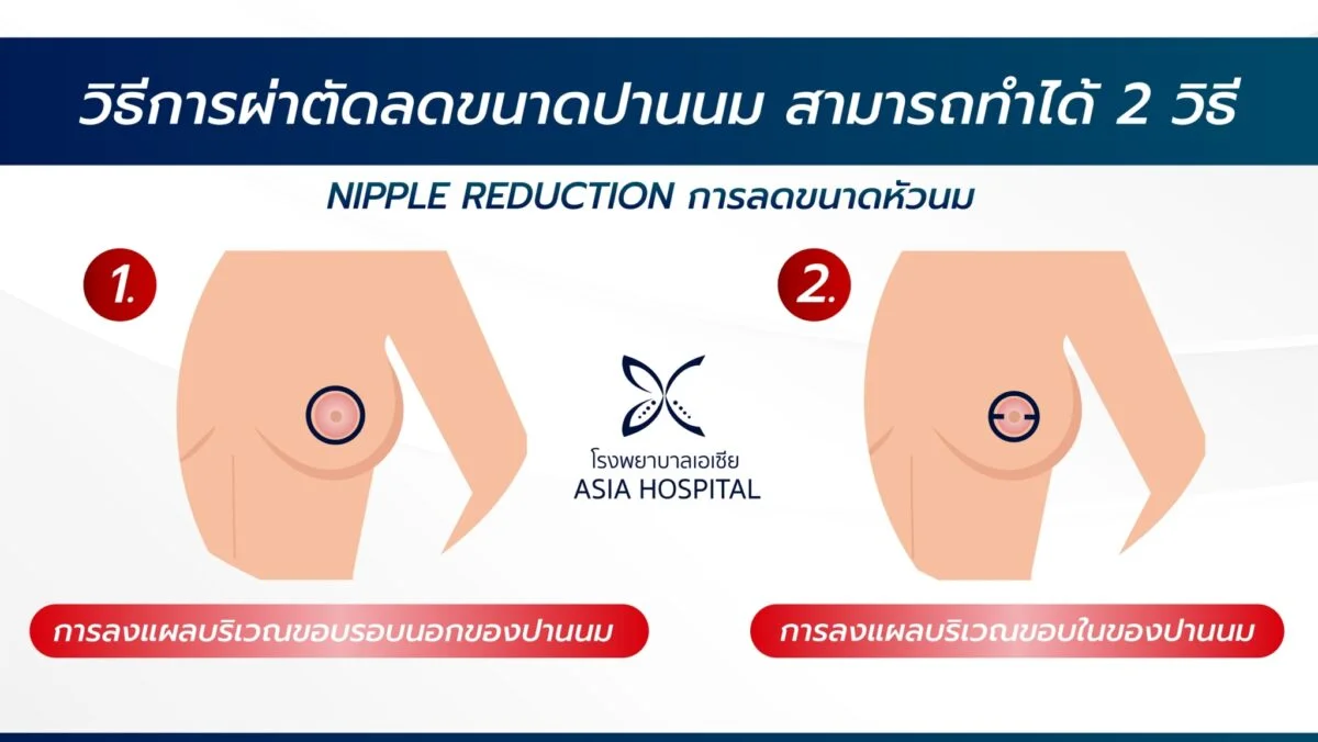 ผ่าตัดลดขนาดปานนม