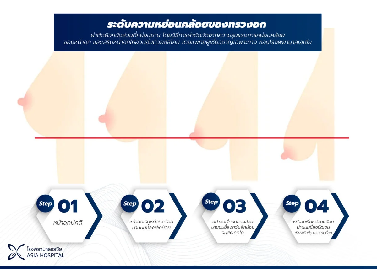 ระดับความหย่อนคล้อยของหน้าอก-ยกกระชับหน้าอก
