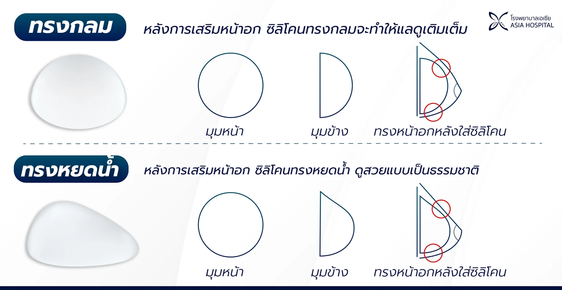 เสริมหน้าอก-ซิลิโคนทรงกลม-ทรงหยดน้ำ