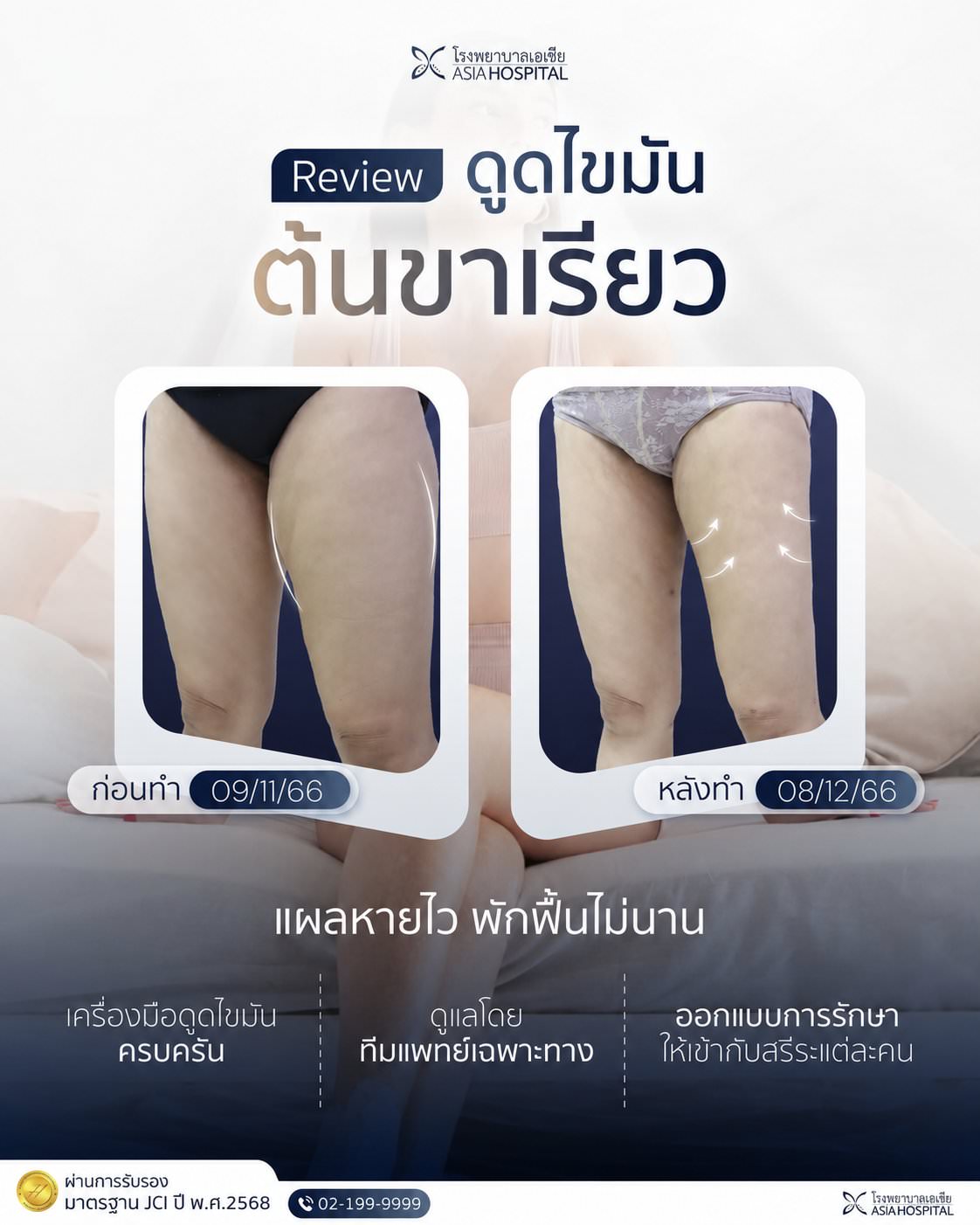 ศัลยกรรมดูดไขมันต้นขา
