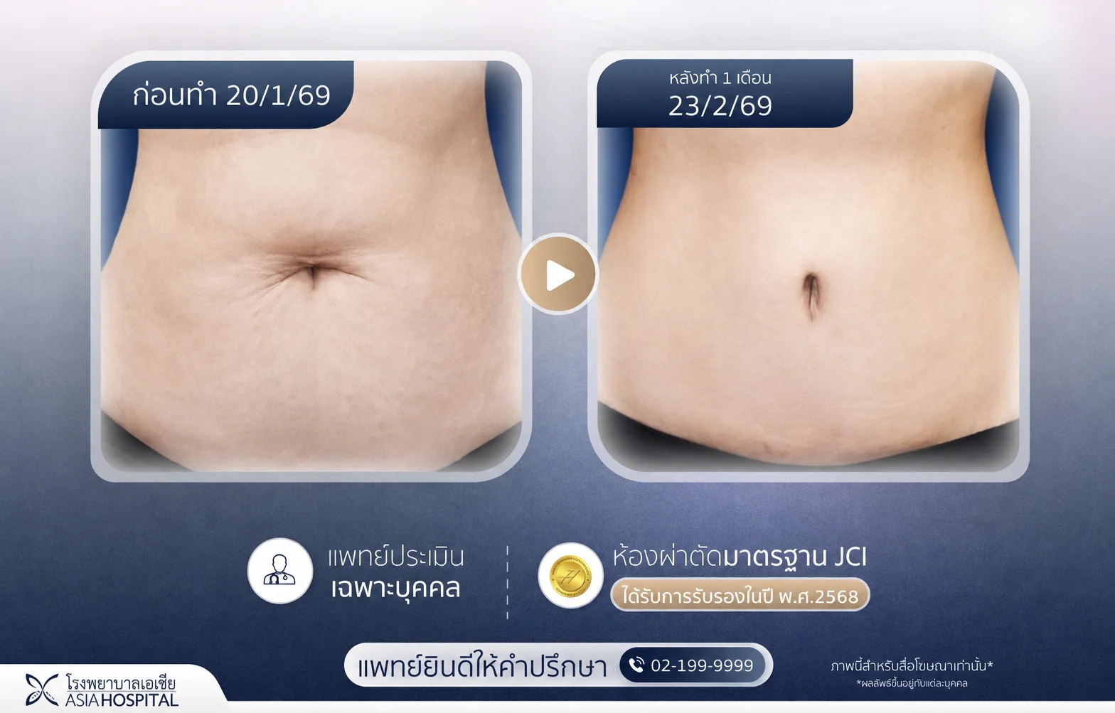 ดูดไขมันหน้าท้อง-ดูดไขมัน