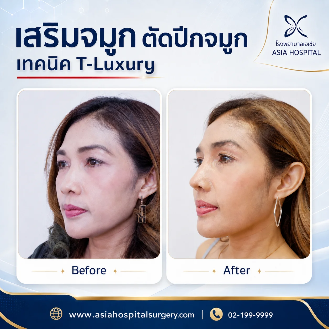 รีวิวตัดปีกจมูก | โรงพยาบาลเอเซีย | โรงพยาบาลเอเซีย รีวิวตัดปีกจมูก