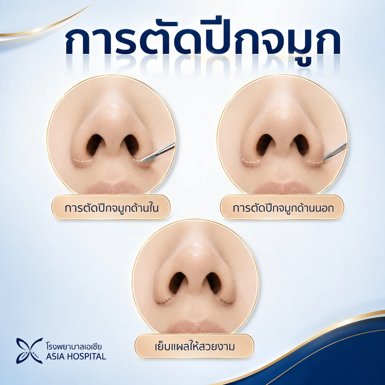ตัดปีกจมูก Alarplasty Surgery | โรงพยาบาลเอเซีย | โรงพยาบาลเอเซีย เทคนิคตัดปีกจมูก