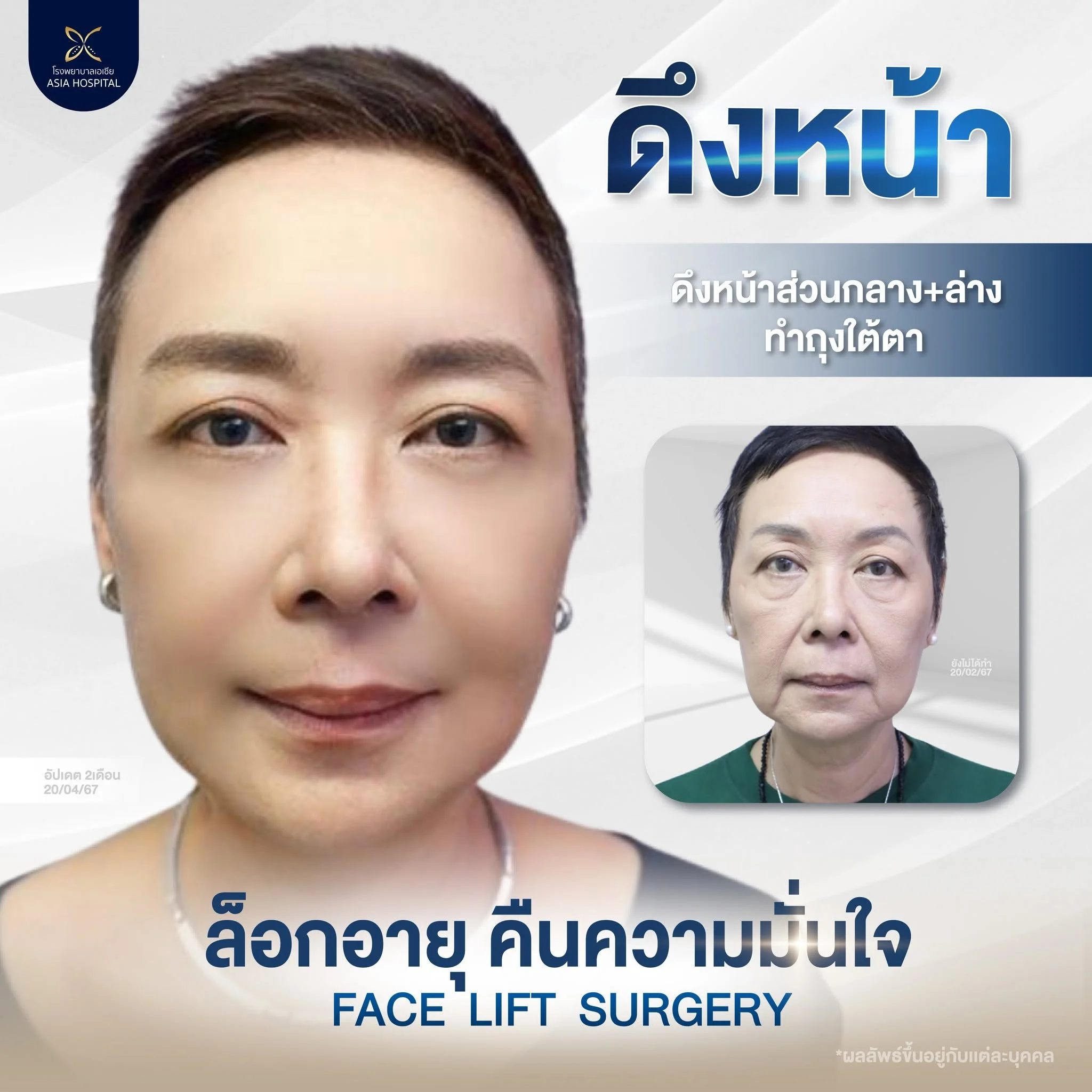รีวิวดึงหน้า_ดึงหน้า