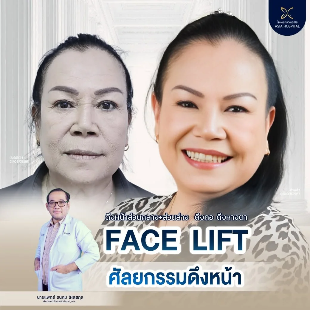 ผ่าตัดดึงหน้า_ดึงหน้า_รีวิวดึงหน้า