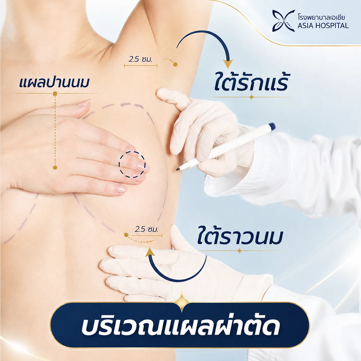 แผลผ่าตัดแก้หน้าอก | โรงพยาบาลเอเซีย | โรงพยาบาลเอเซีย แผลผ่าตัด_แก้หน้าอก_แก้ไขหน้าอก
