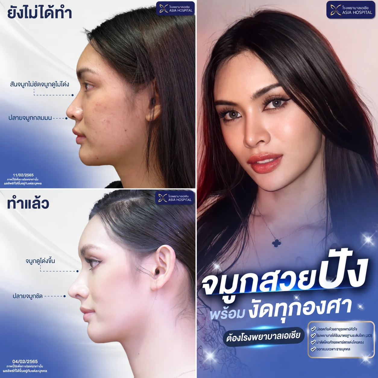 รีวิวเสริมจมูก | โรงพยาบาลเอเซีย | โรงพยาบาลเอเซีย รีวิวก่อนหลัง-เสริมจมูก