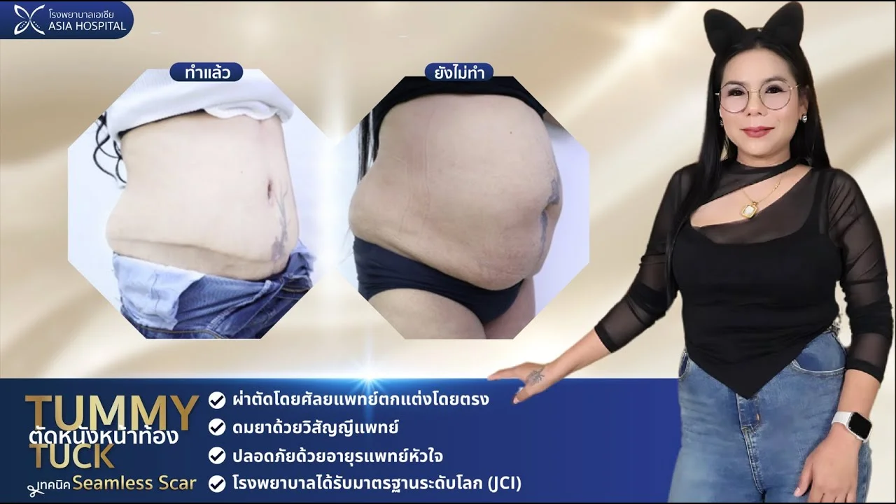 tummytuck-review-02 → โรงพยาบาลเอเซีย → โรงพยาบาลเอเซีย รีวิวตัดหนังหน้าท้อง-หลังผ่าตัดหนังหน้าท้อง
