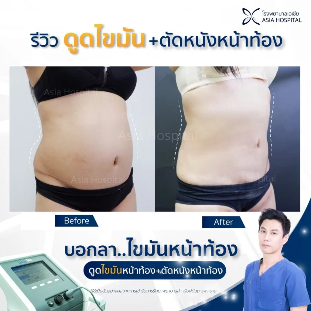 รีวิวดูดไขมัน-ตัดหนังหน้าท้อง