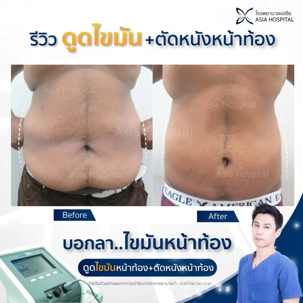 รีวิวดูดไขมัน-ตัดหนังหน้าท้อง