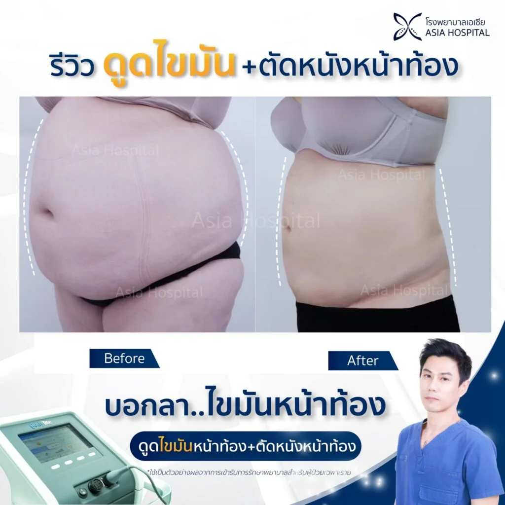 รีวิวดูดไขมัน-ตัดหนังหน้าท้อง