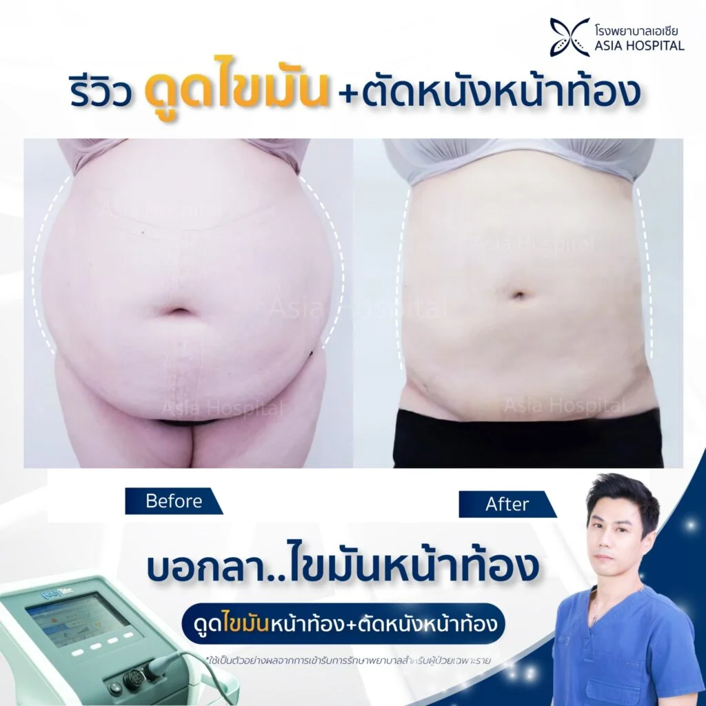 รีวิวดูดไขมัน-ตัดหนังหน้าท้อง