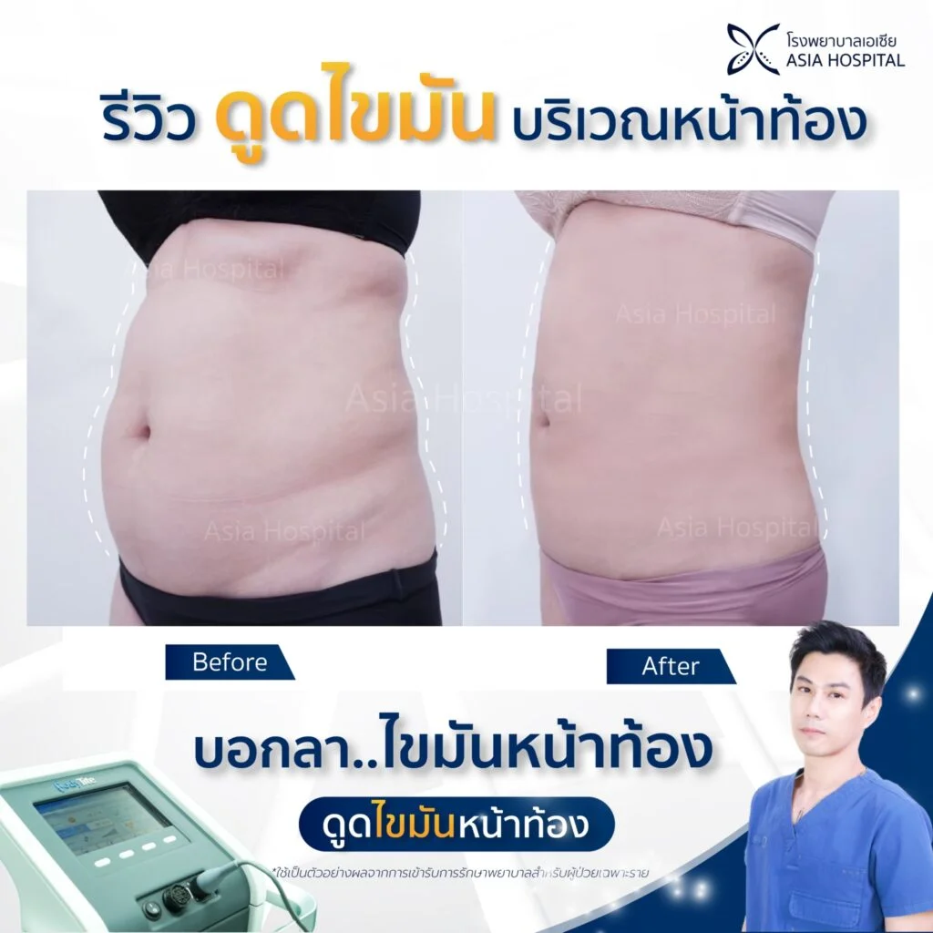 รีวิวดูดไขมัน-VASER