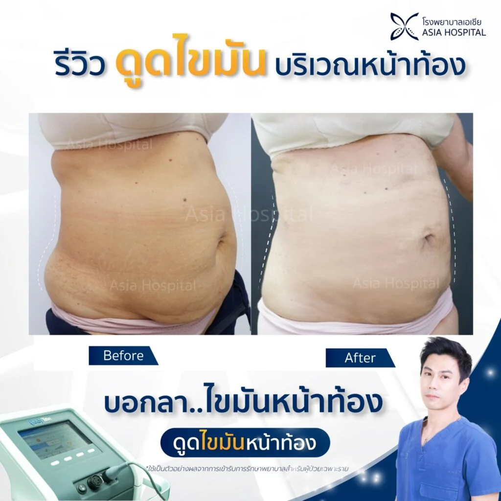 รีวิวดูดไขมัน-ตัดหนังหน้าท้อง