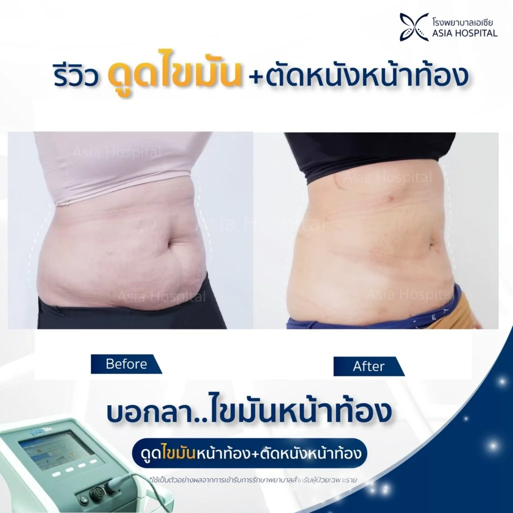 รีวิวดูดไขมัน-ตัดหนังหน้าท้อง
