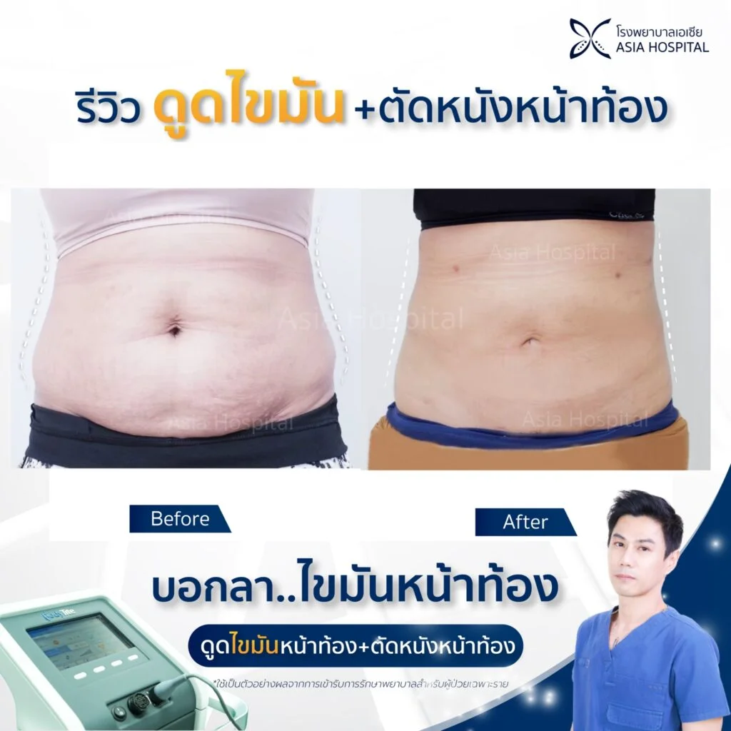 รีวิวดูดไขมัน-ตัดหนังหน้าท้อง