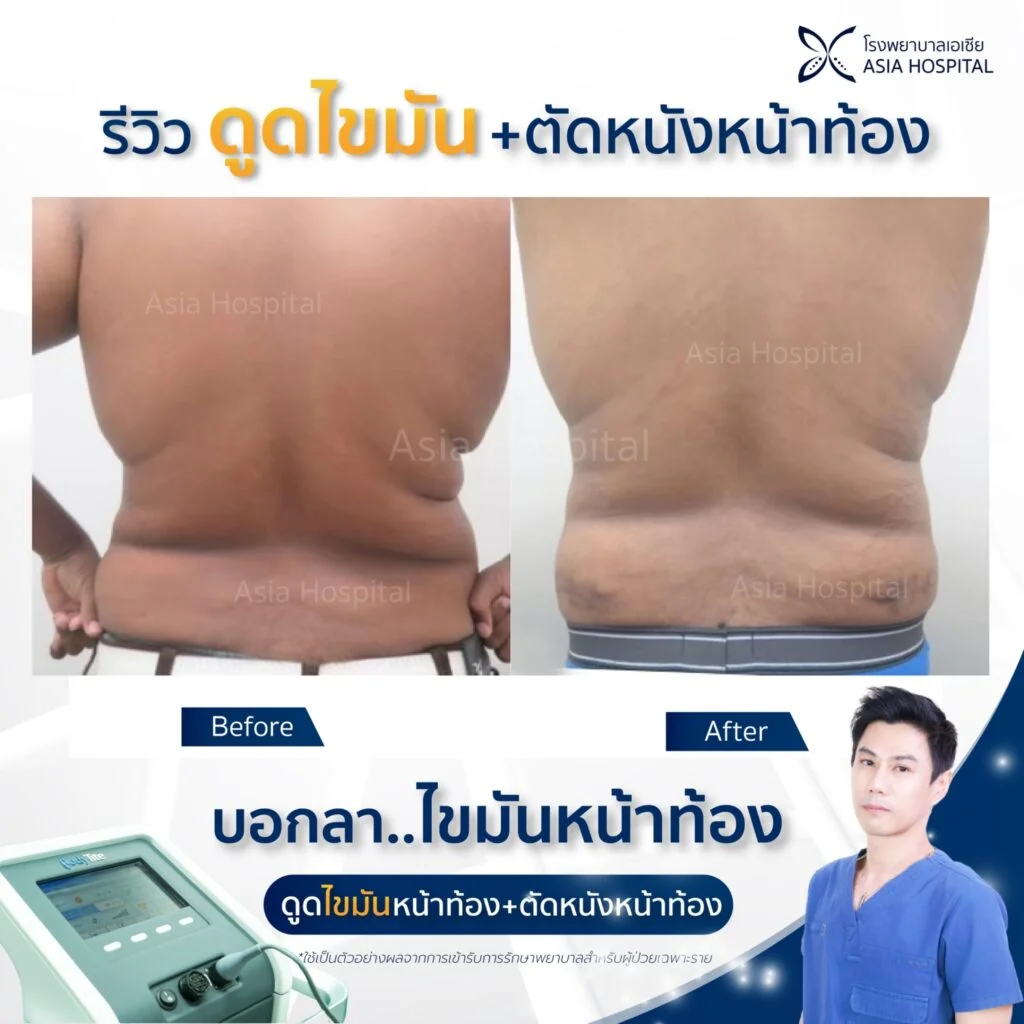 ดูดไขมันปีกหลัง_ดูดไขมันหลัง