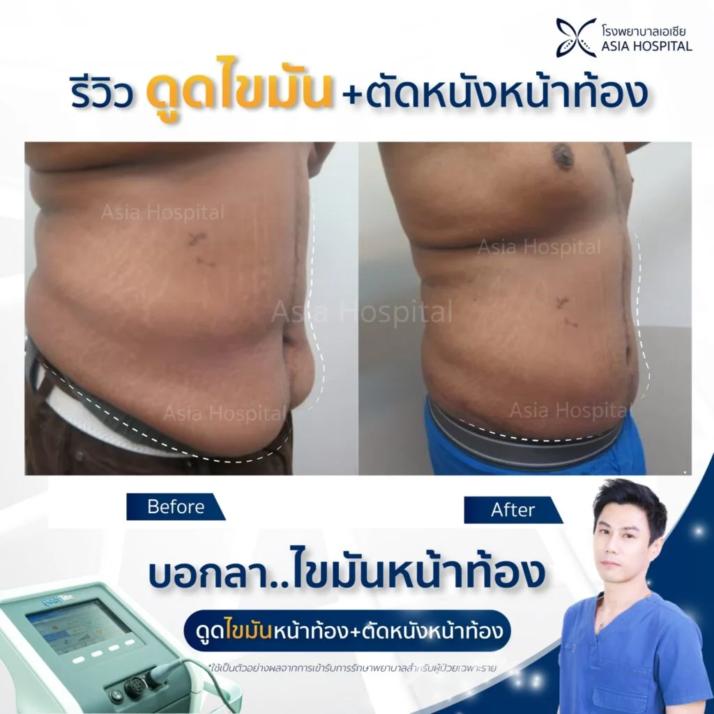 รีวิวดูดไขมัน-ตัดหนังหน้าท้อง