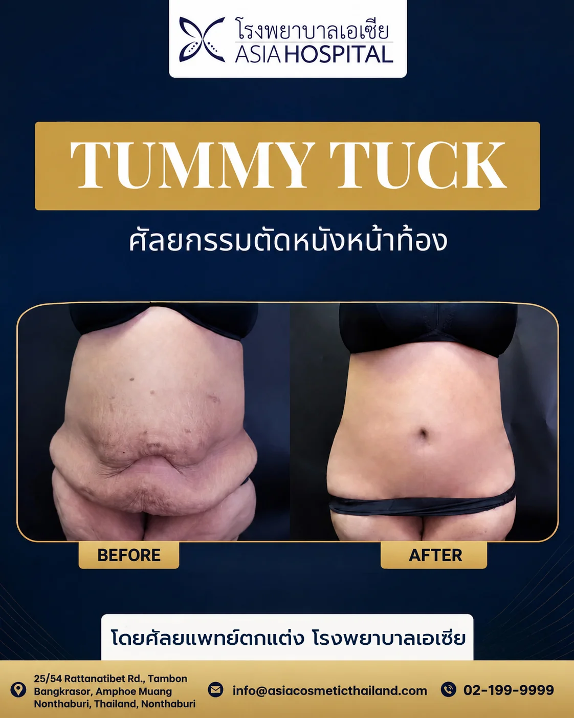 รีวิวตัดหนังหน้าท้อง-ตัดหนังหน้าท้องที่ไหนดี