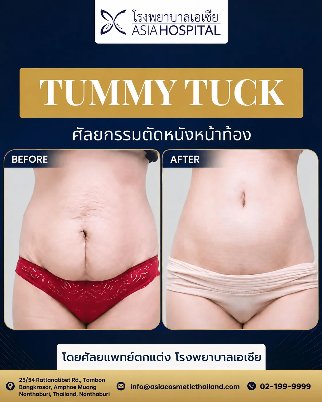 รีวิวตัดหนังหน้าท้อง-ย้ายสะดือ