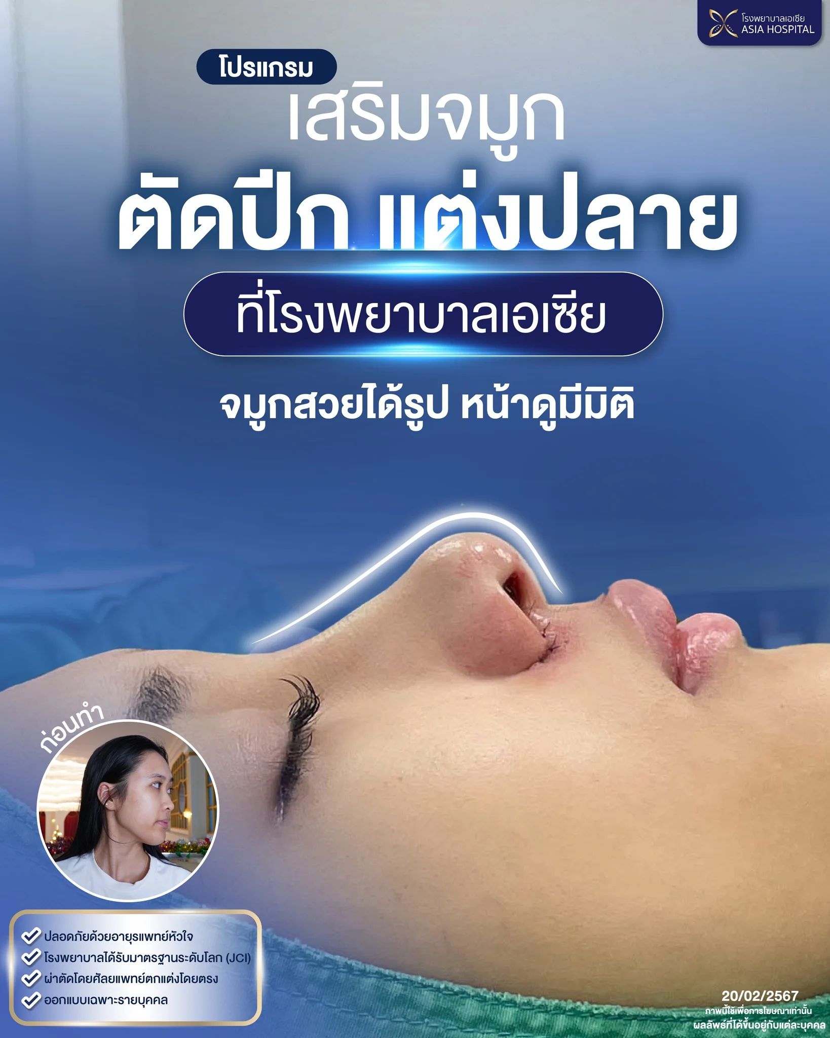 รีวิวตัดปีกจมูก | โรงพยาบาลเอเซีย | โรงพยาบาลเอเซีย รีวิวตัดปีกจมูก-หลังทำทันที