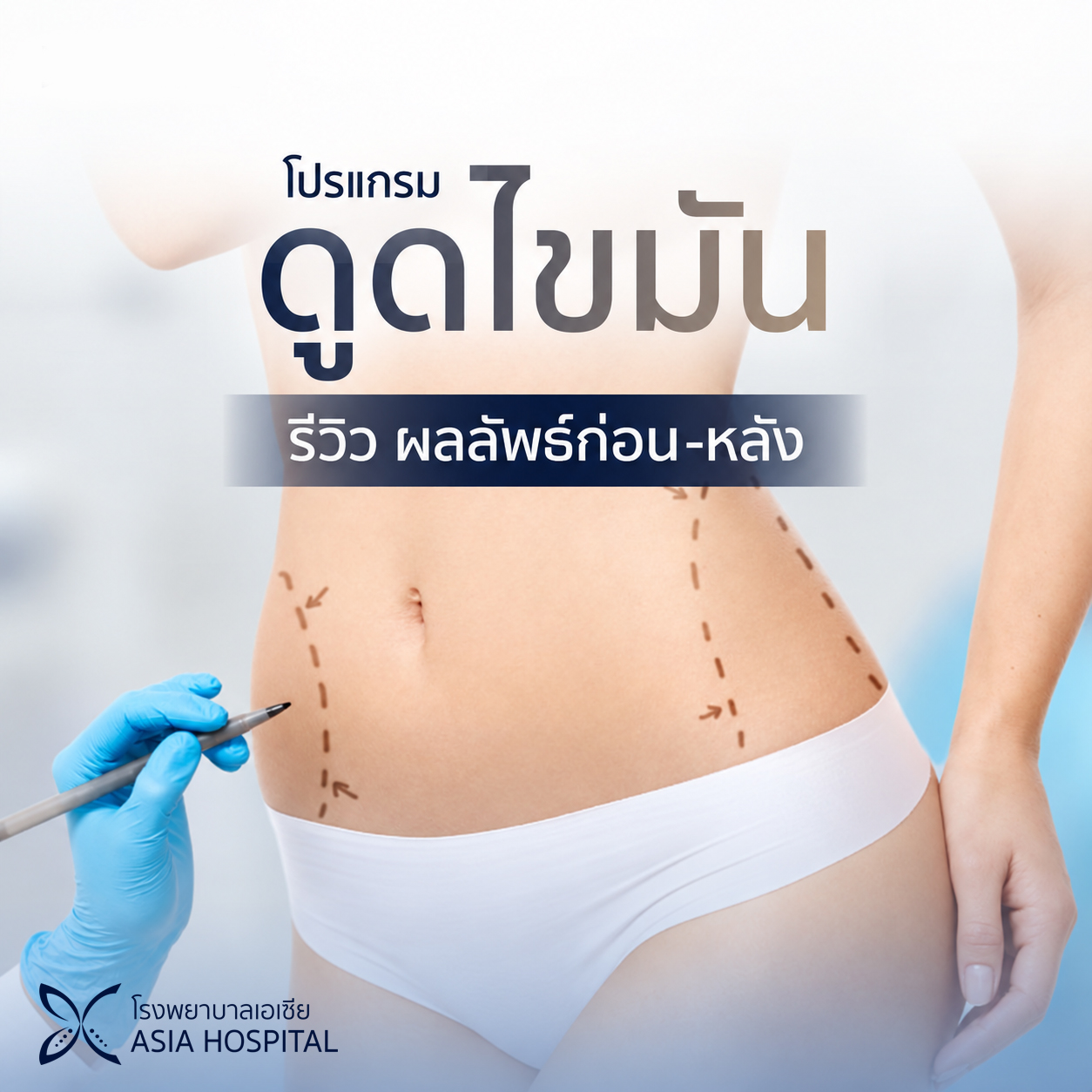 รีวิวดูดไขมัน