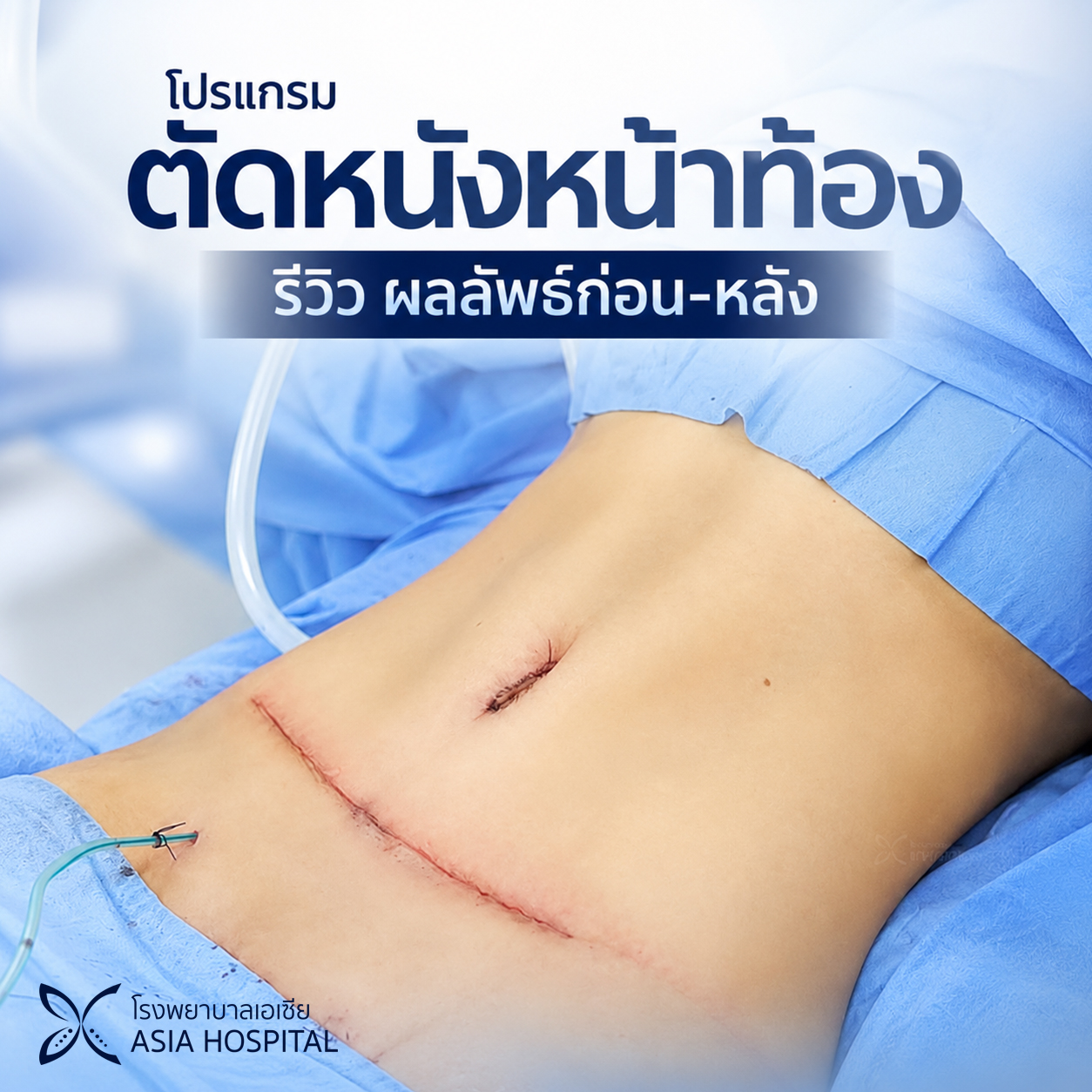 รีวิวตัดหนังหน้าท้อง