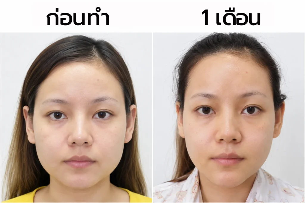 หลังตัดกราม1เดือน