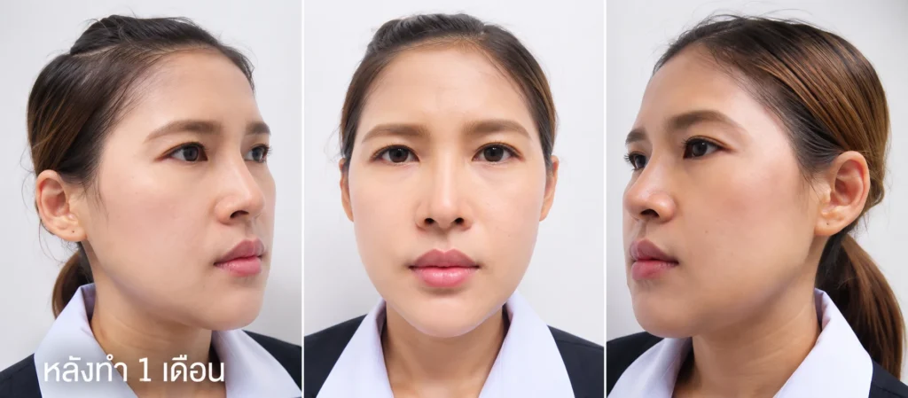 หลังยุบโหนก ตัดกราม 1เดือน