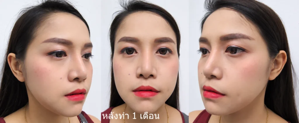 หลังทำ 1 เดือน ปรับโครงหน้า ตัดกราม กรอกราม