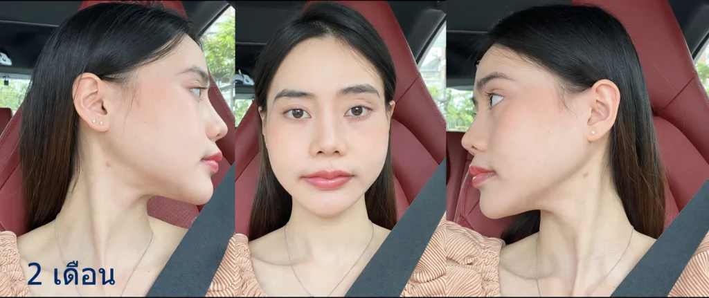 ยุบโหนก ตัดกราม กรอกราม แก้ไขคางเล็ก หลังทำ 2 เดือน