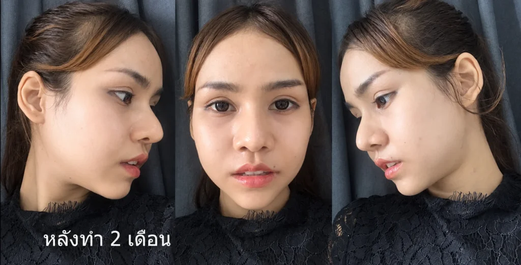 หลังทำ 2 เดือน ศัลยกรรมลดโหนกแก้ม ยุบโหนกแก้ม