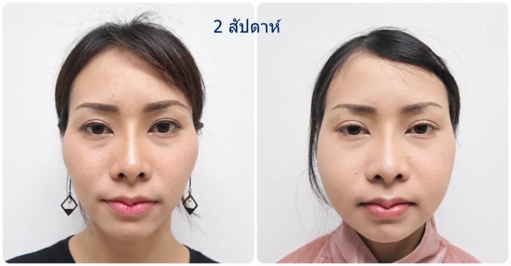หลังยุบโหนกแก้ม 2 สัปดาห์